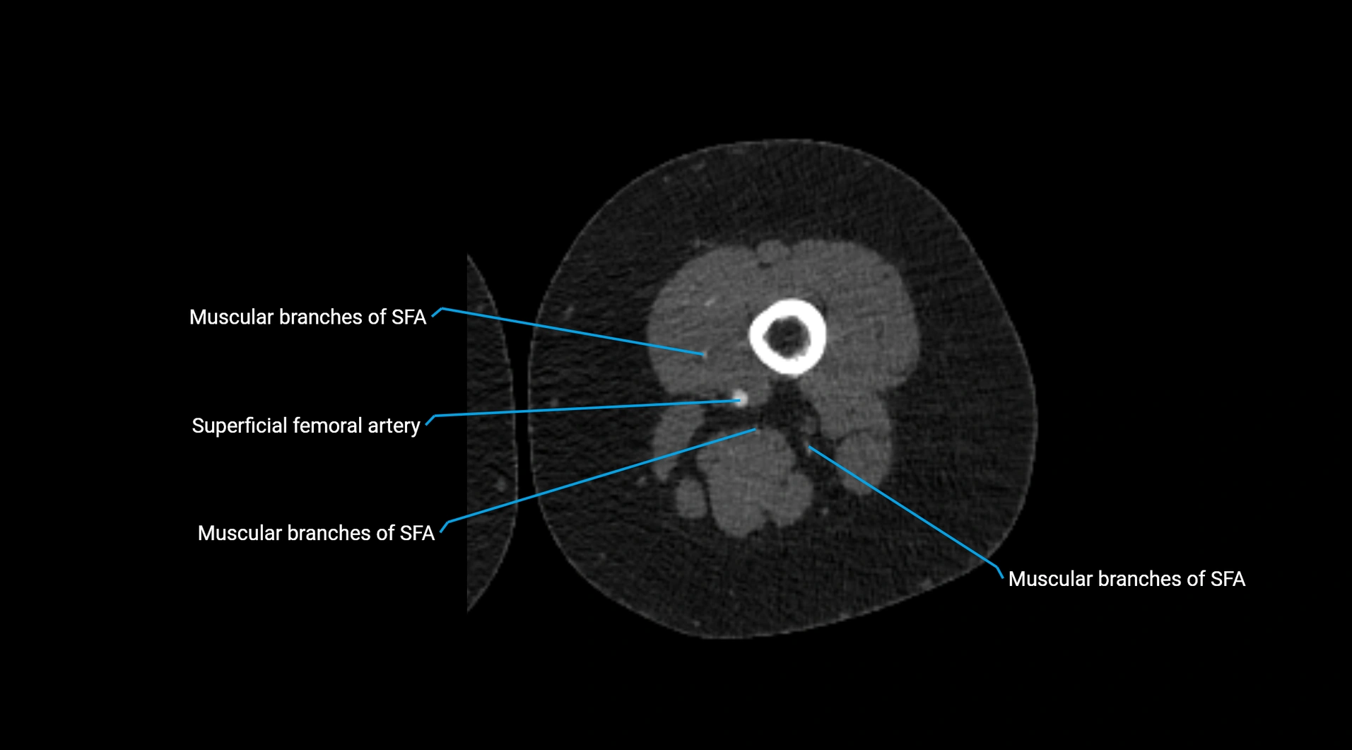 CTA lower limb cross sectional anatomy labelled image _143.webp